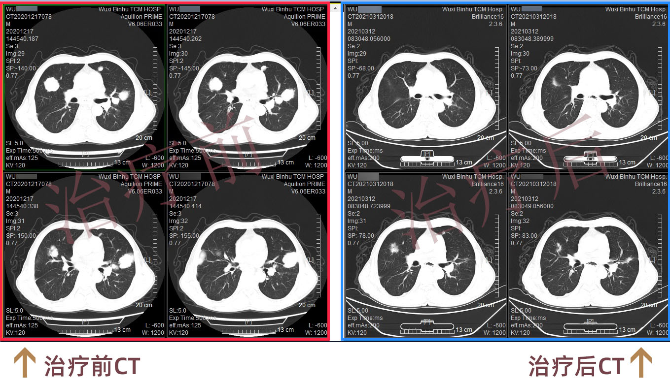 CT前后对比图.jpg